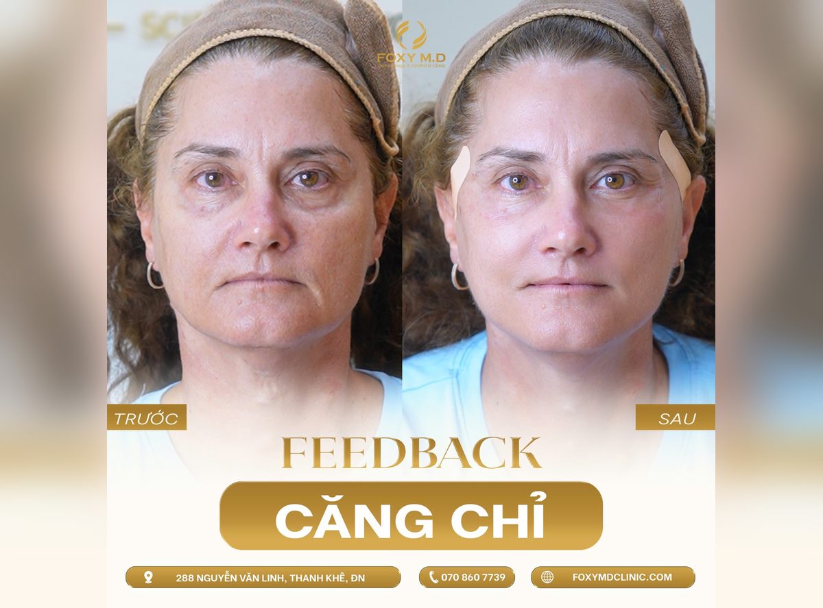 Trước và sau căng chỉ trẻ hóa da của khách hàng người Nga tại Foxy M.D