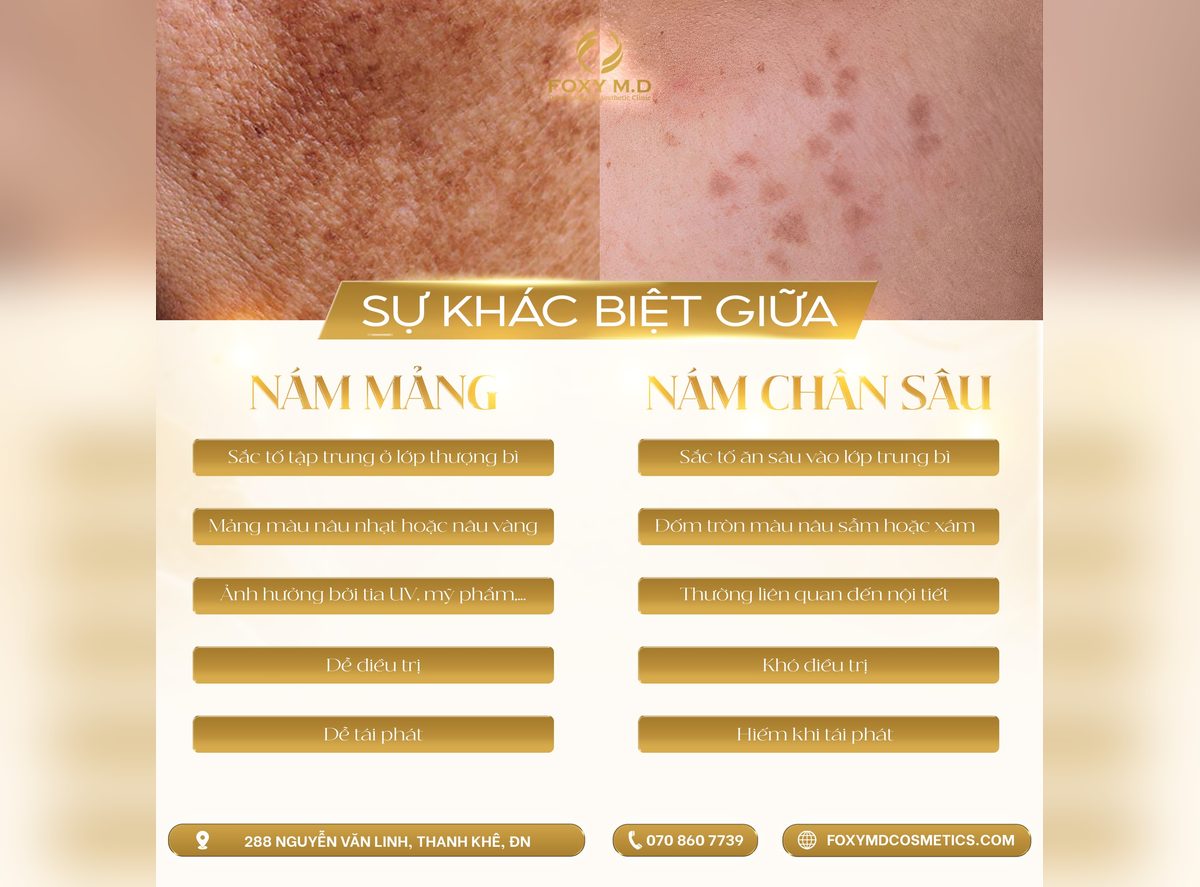 Nám mảng hay nám chân sâu? Cách phân biệt
