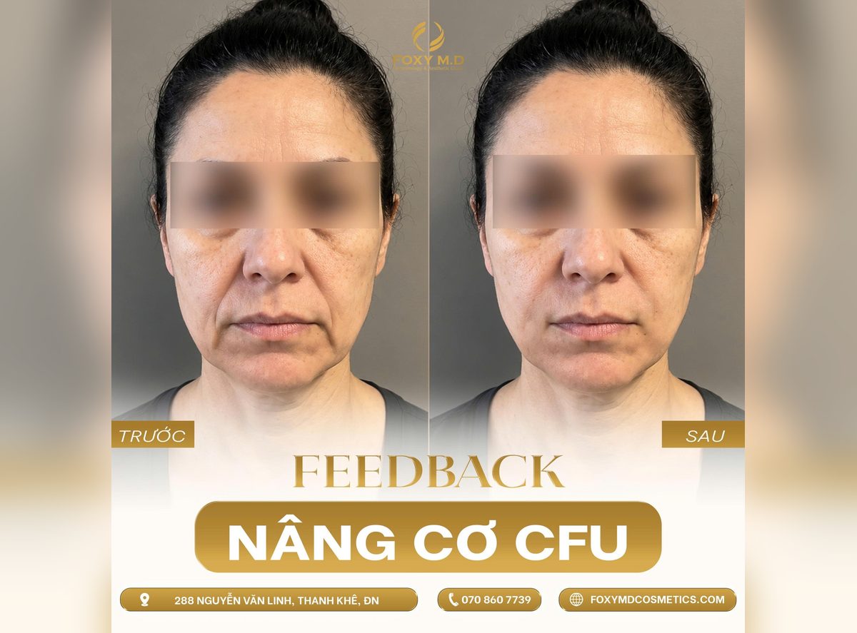 Nâng cơ CFU V-MAX trước và sau