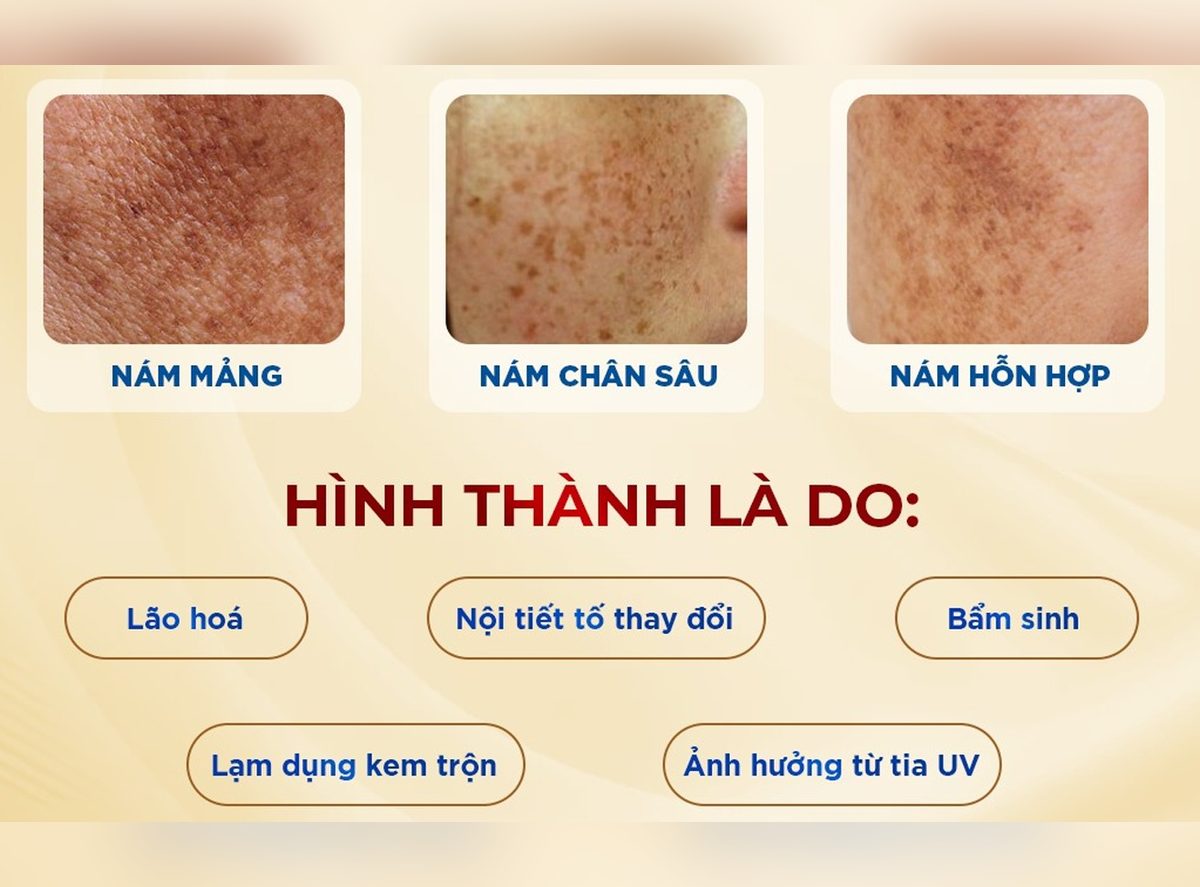Ảnh da thật 3 loại nám: nám mảng, nám chân sâu, nám hỗn hợp và 5 nguyên nhân hình thành nám