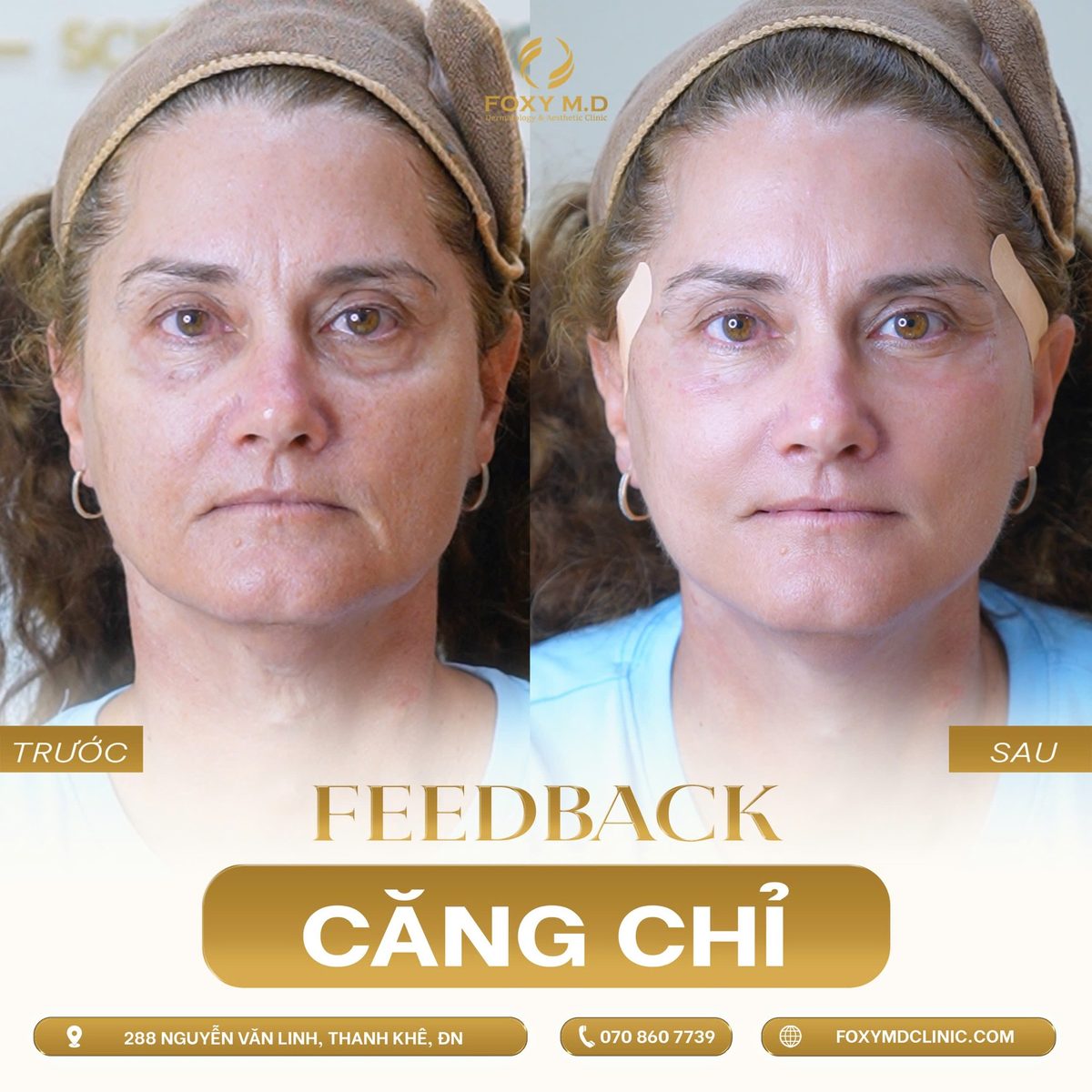 Trước sau căng chỉ trẻ hóa da khách hàng người Nga tại Foxy M.D Đà Nẵng