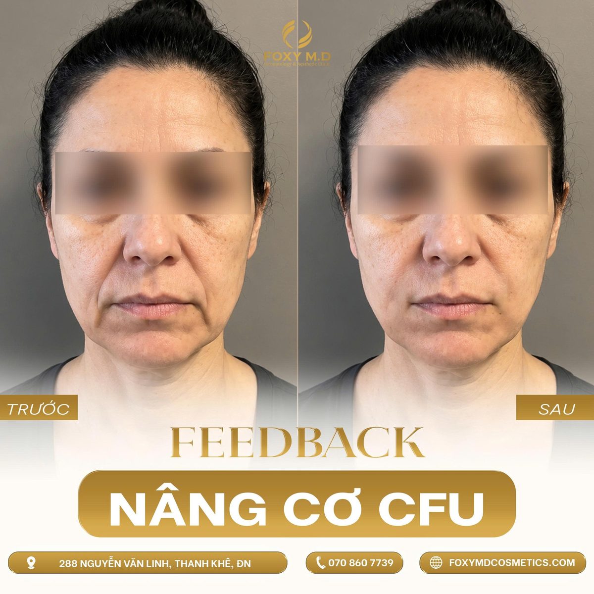 Trước sau nâng cơ CFU V-MAX góc thẳng