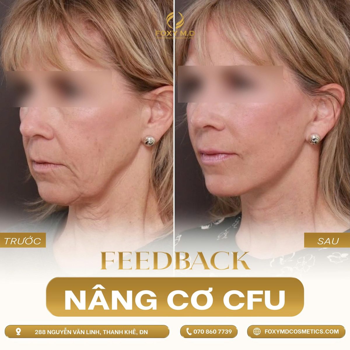 Trước sau nâng cơ CFU V-MAX góc nghiêng viền hàm