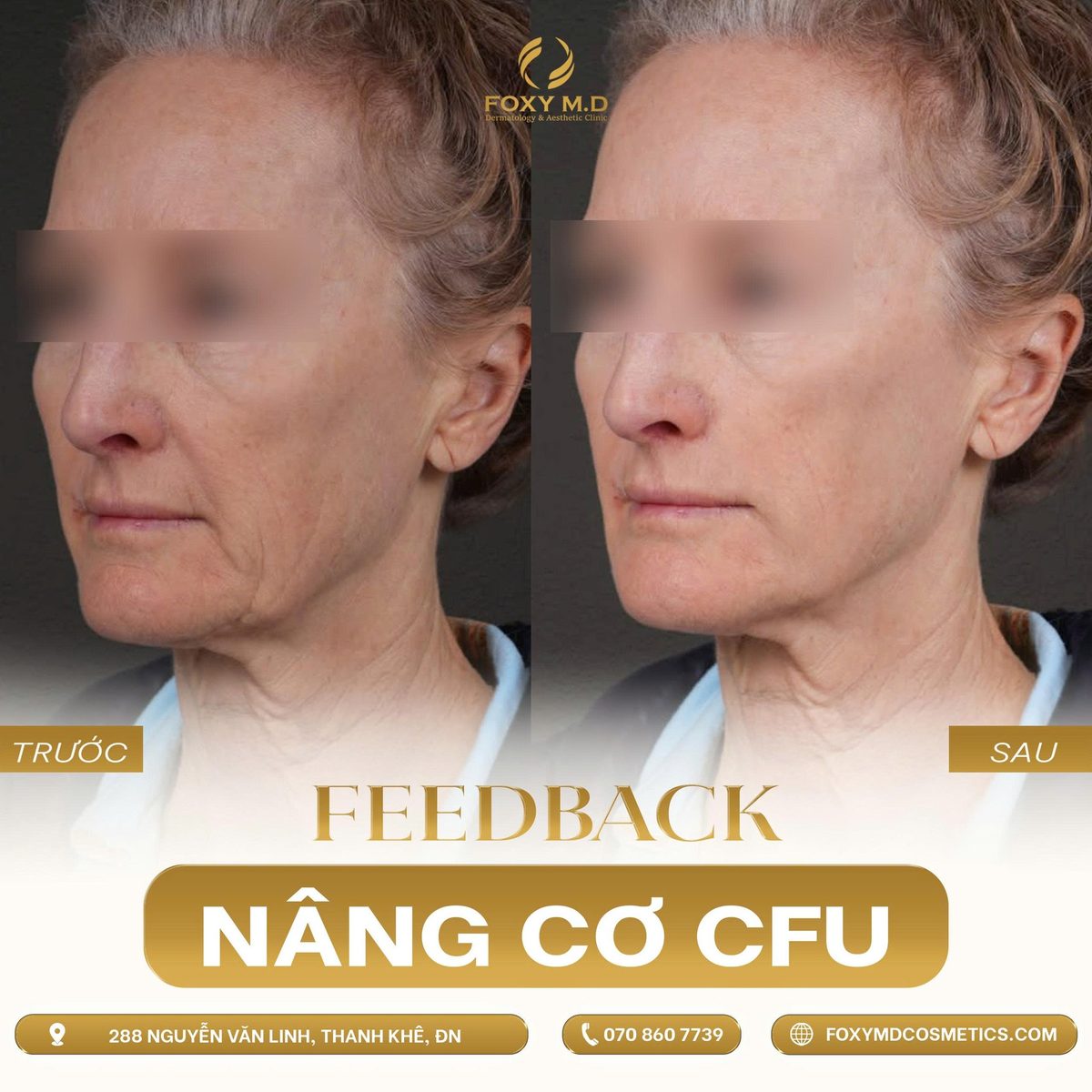 Trước sau nâng cơ CFU V-MAX vùng má và rãnh cười