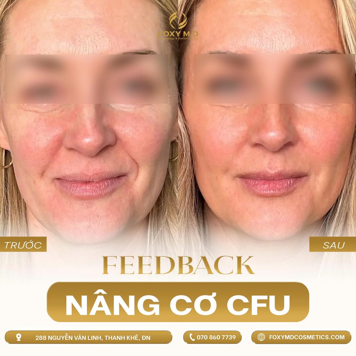 Trước sau nâng cơ CFU V-MAX chất lượng da