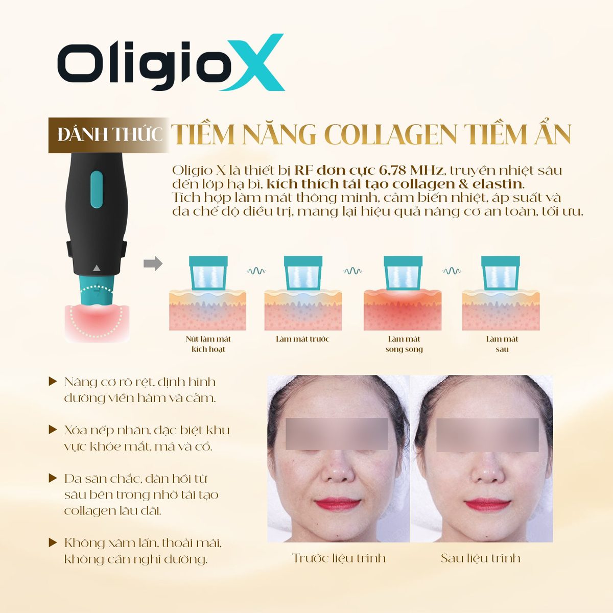 Đầu tip Oligio X và các vùng điều trị trên gương mặt