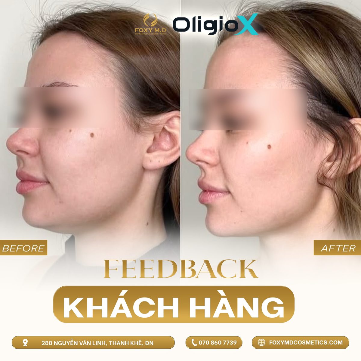 Ảnh trước và sau liệu trình Oligio X vùng má và viền hàm được Foxy M.D chia sẻ trên fanpage