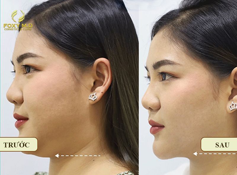 Tiêm trẻ hóa Sculptra · CaHA tại Đà Nẵng 4