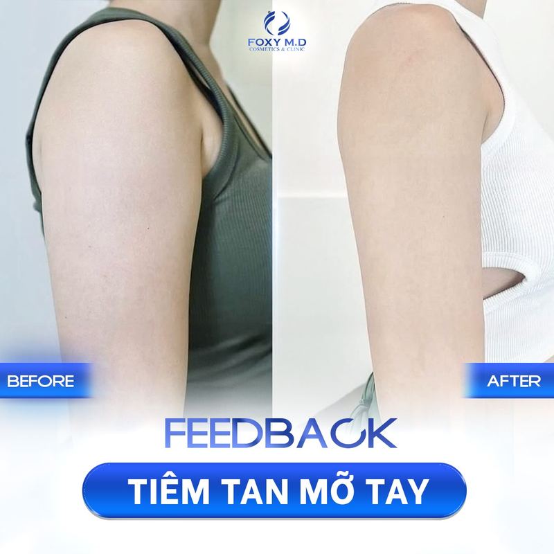 Tiêm tan mỡ tại Đà Nẵng 4
