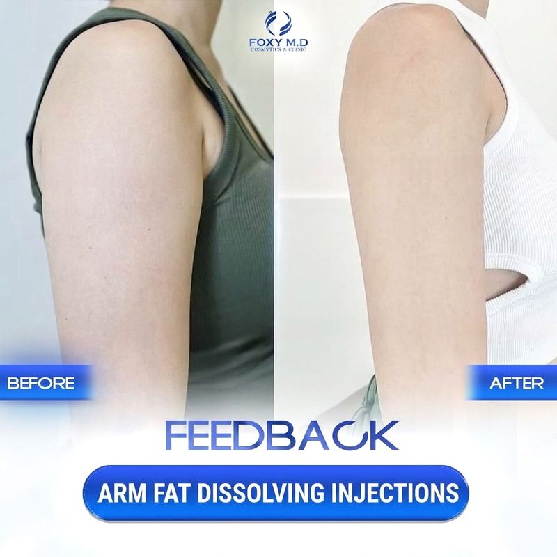 Fat Dissolving Injection in Da Nang 4